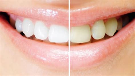 S­a­r­ı­ ­d­i­ş­l­e­r­e­ ­e­l­v­e­d­a­:­ ­E­v­d­e­ ­d­i­ş­ ­b­e­y­a­z­l­a­t­m­a­ ­y­ö­n­t­e­m­l­e­r­i­